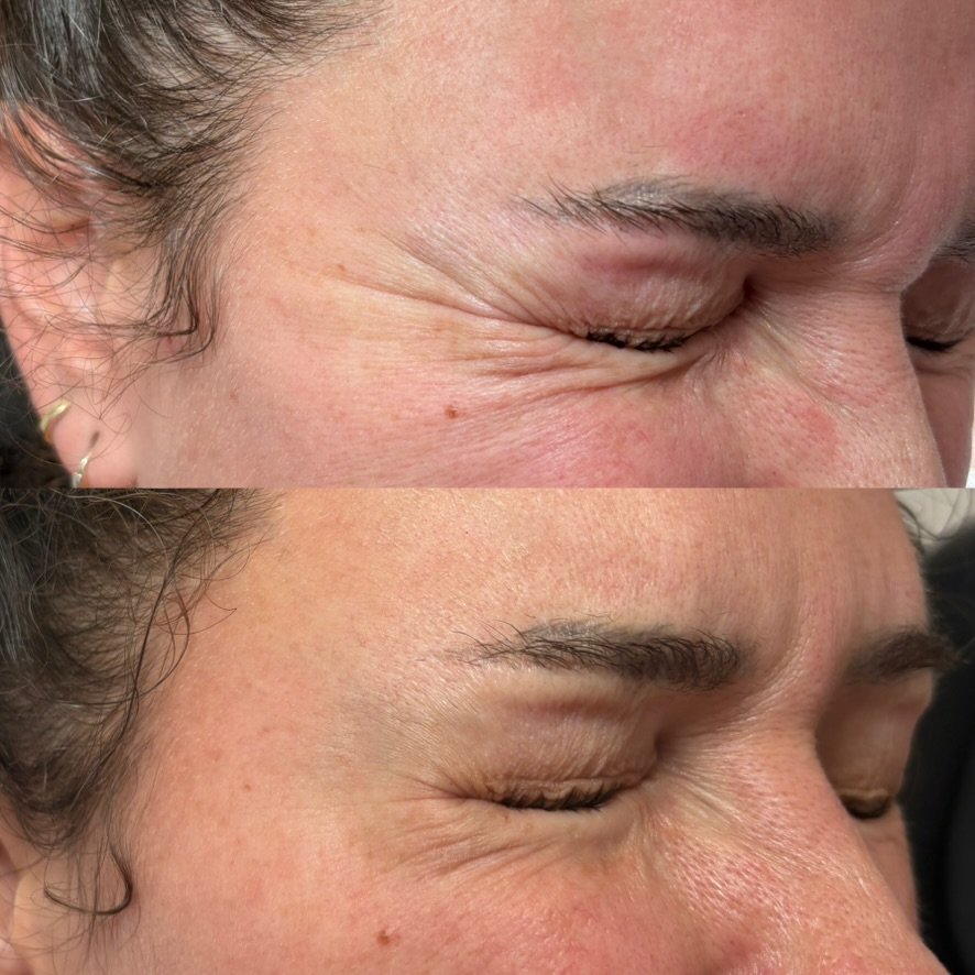 Crow's feet, 1 treatment