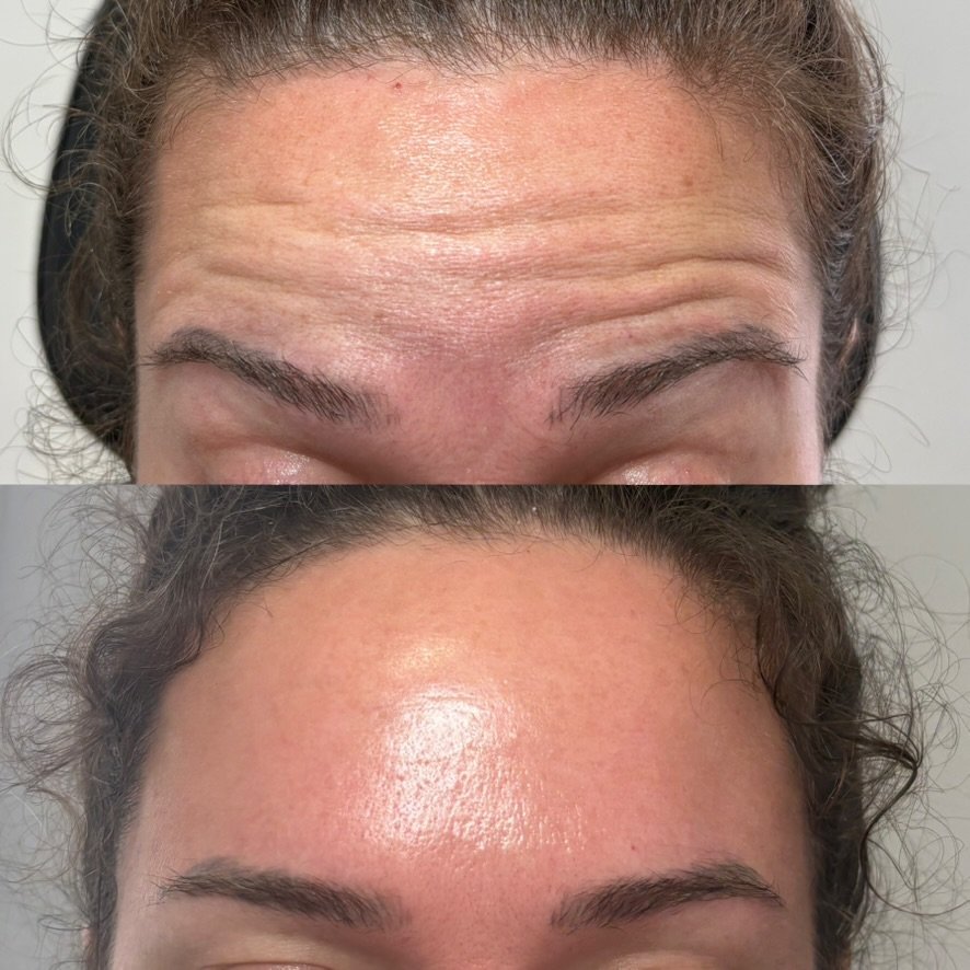 First-time Botox client, 1 treatment