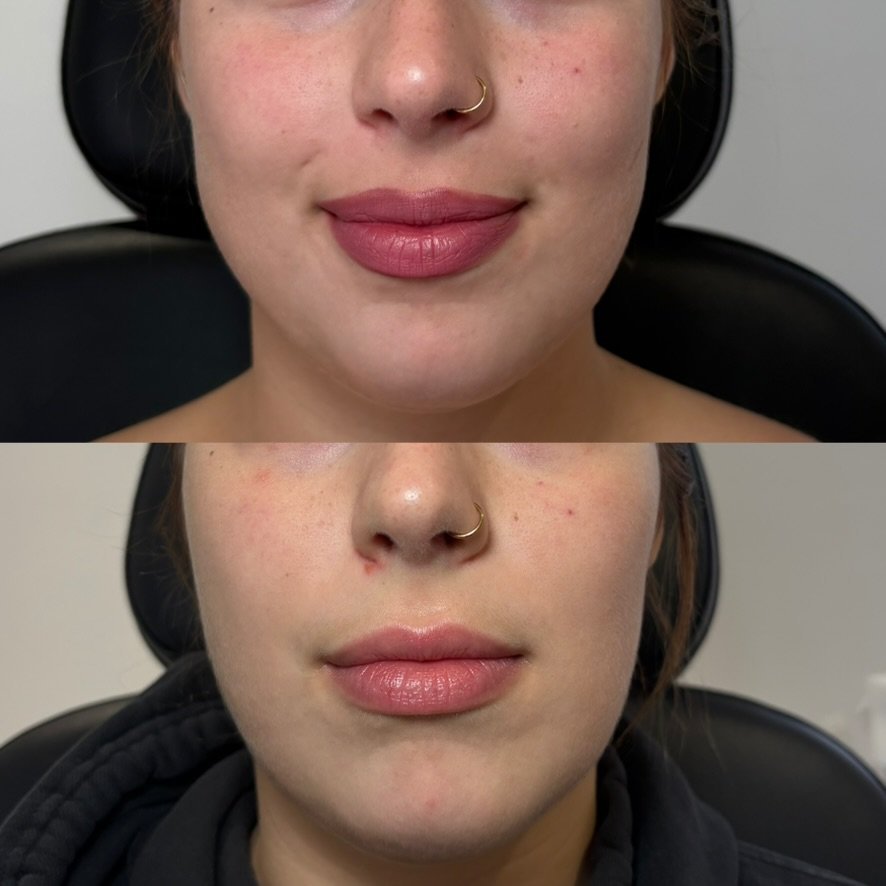 Masseter — jaw slimming and TMJ