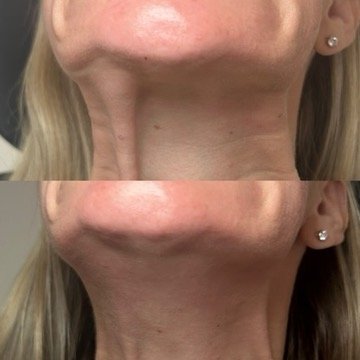 Platysmal bands, 1 treatment