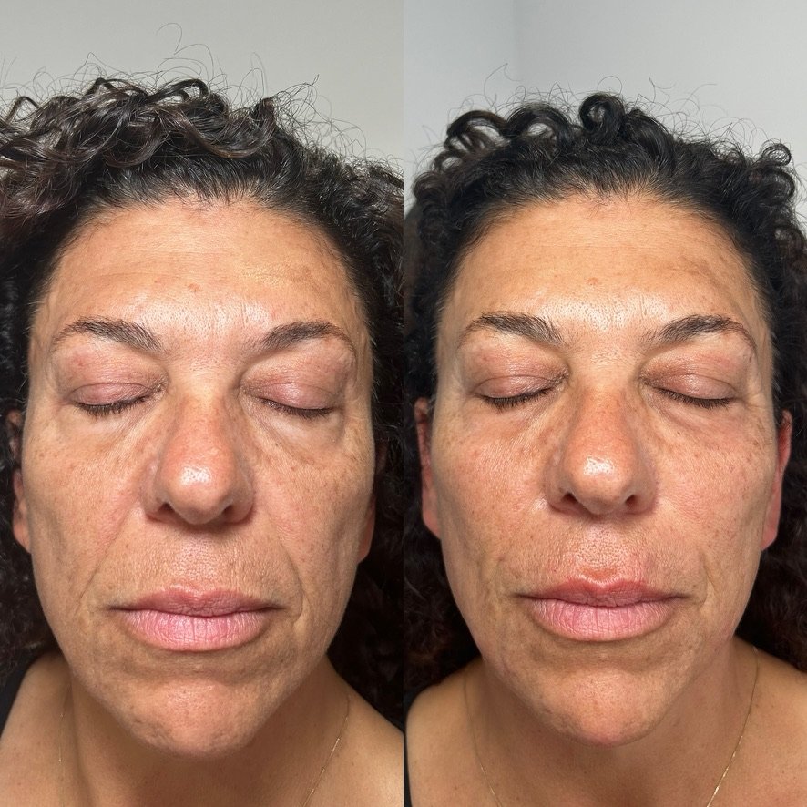 Dermal filler — multi-area treatment