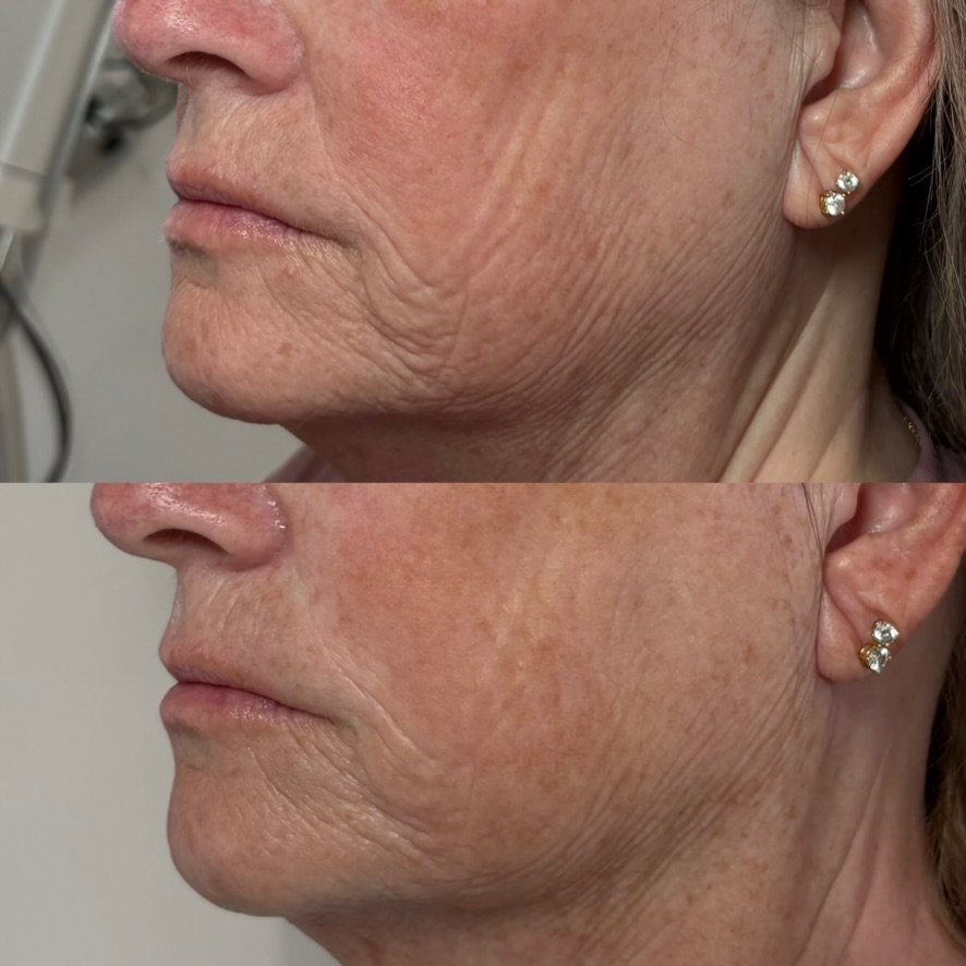 Laser resurfacing