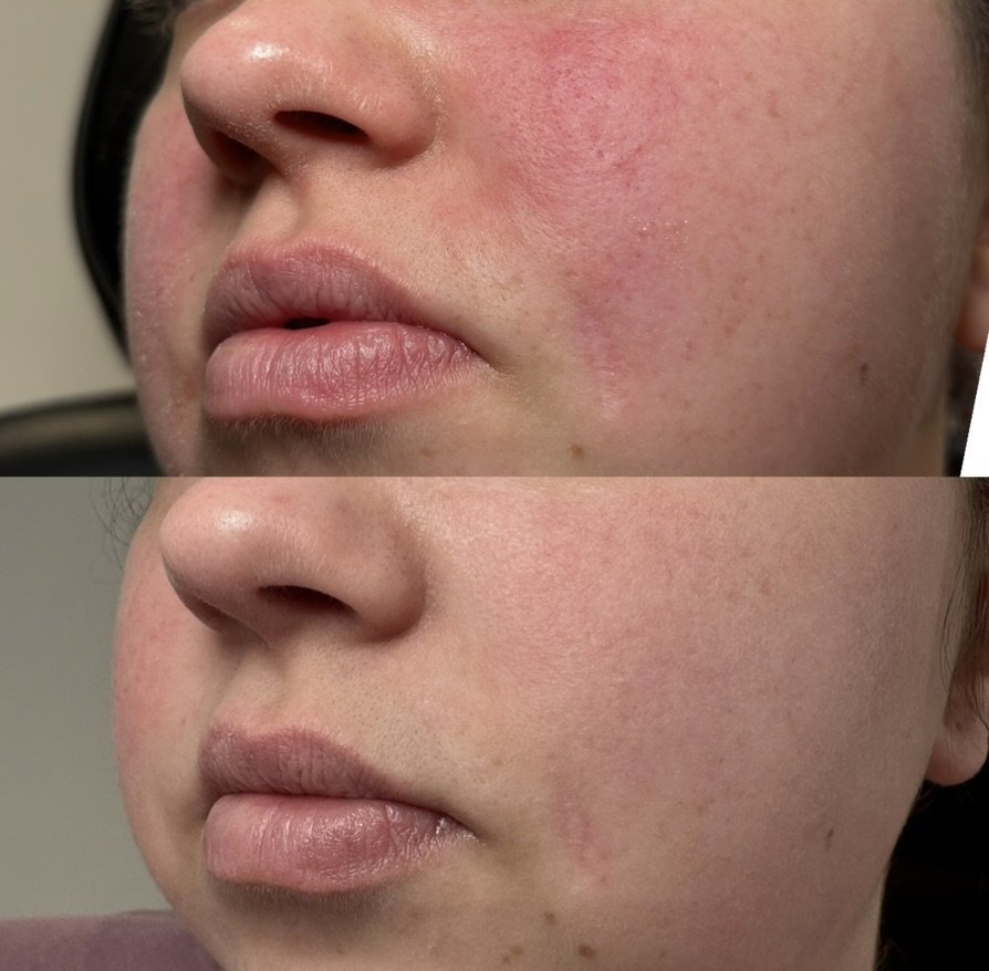 Deep Fractional for redness, after 2 treatments