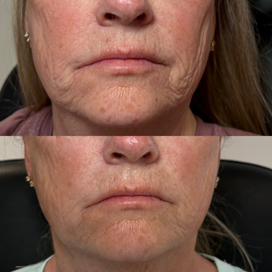 Deep fractional resurfacing — texture, 2 treatments