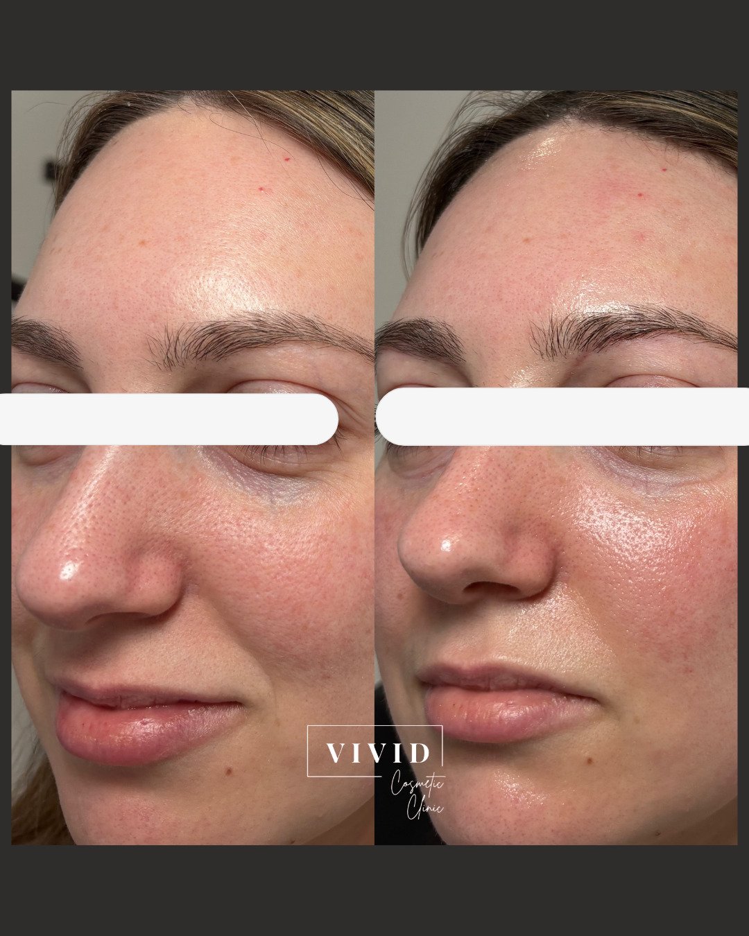 Naturapeel Hollywood facial