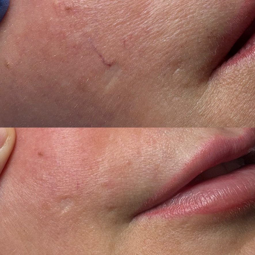 Laser vein treatment