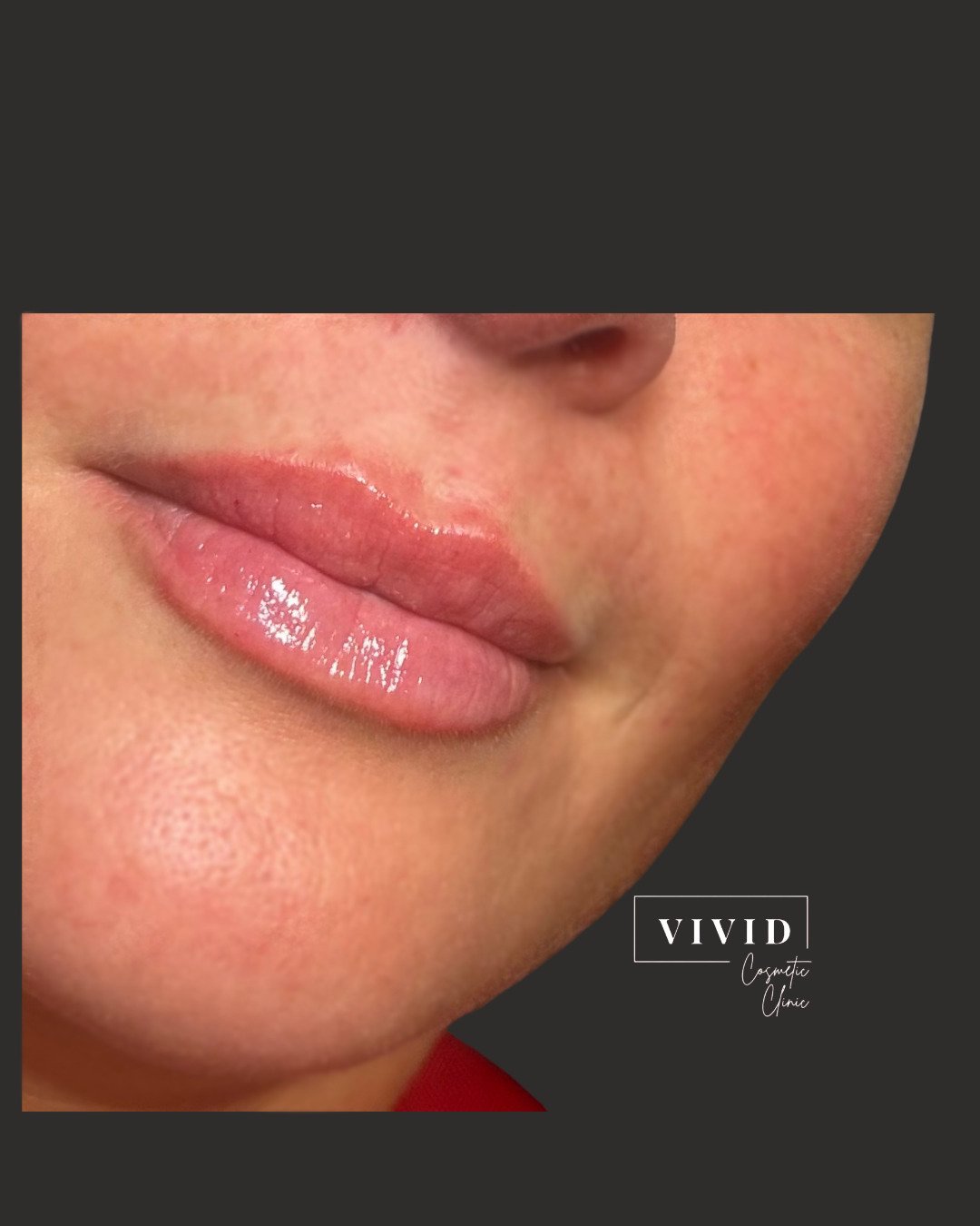 Lip filler — hydration and definition