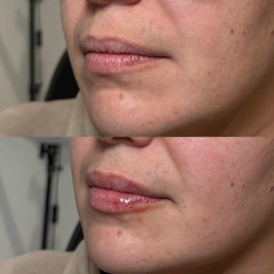 Dermal filler — lip