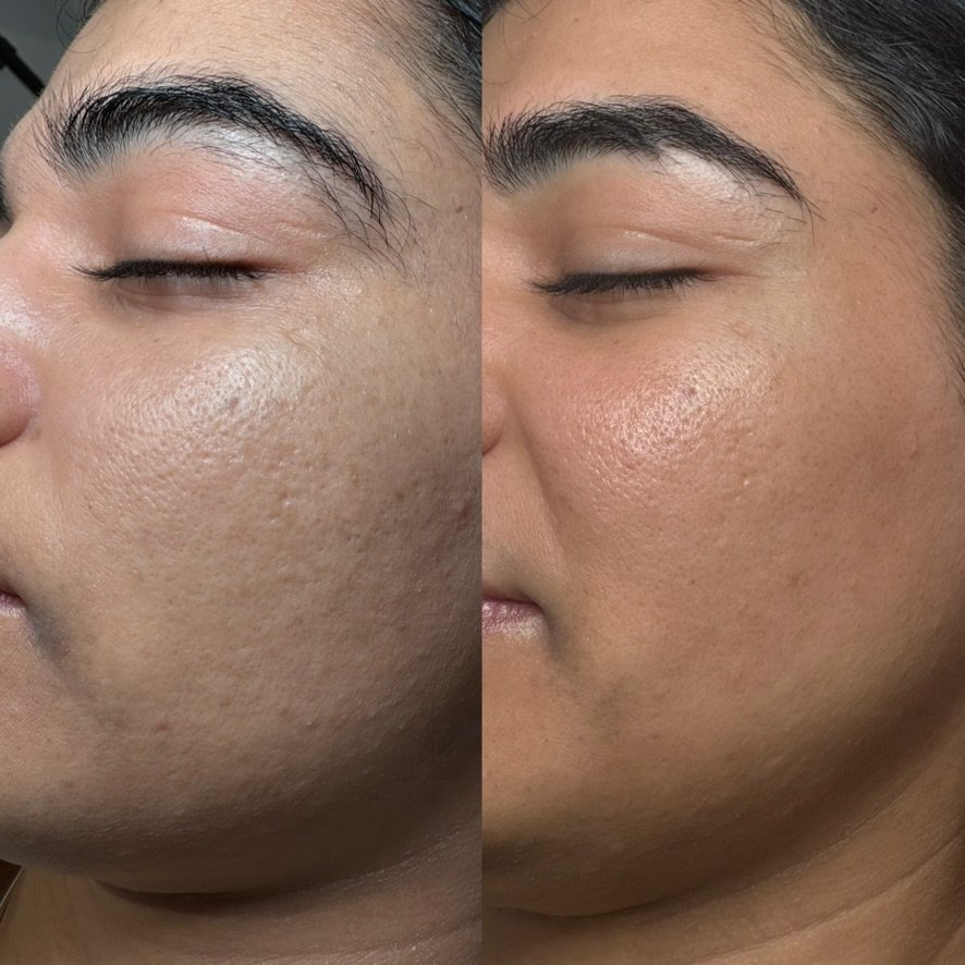 Microneedling