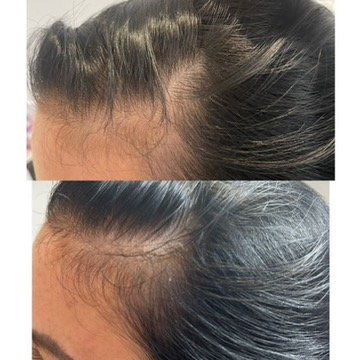 PRP hair restoration — 1 session