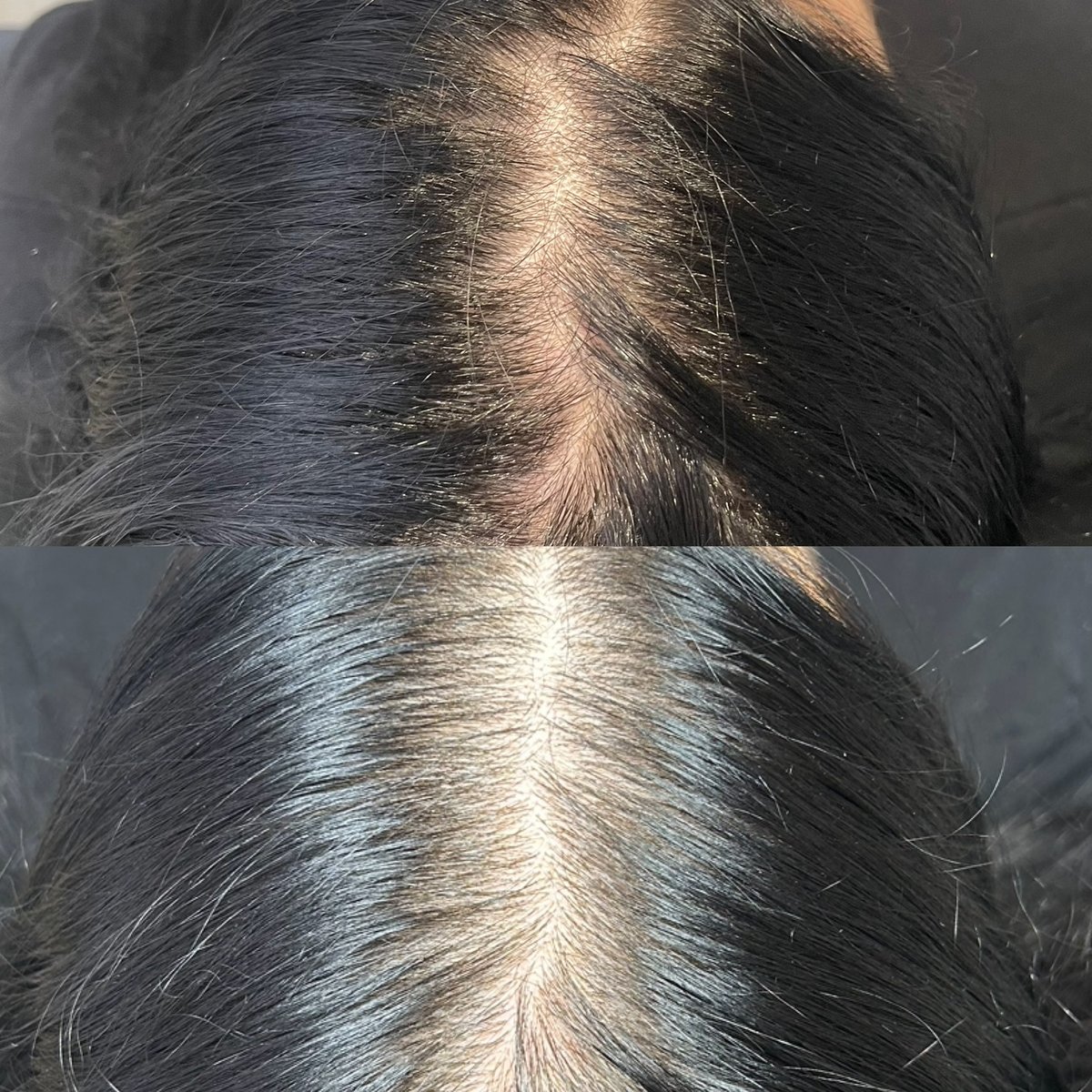PRP hair restoration — 1 session