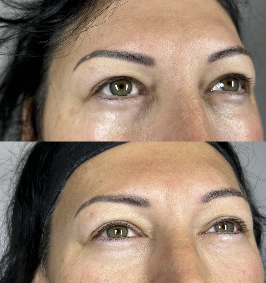 PRP under-eye — 1 session