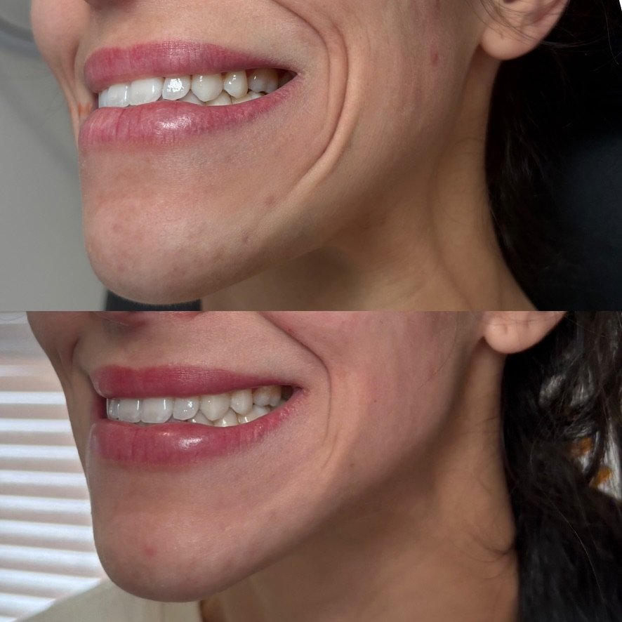 Accordion lines, 1 treatment