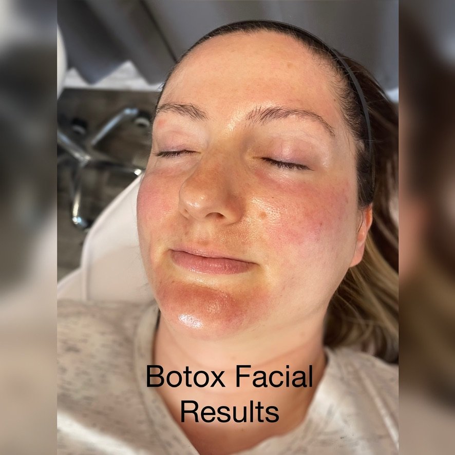 Glass Facial — immediate post-treatment glow